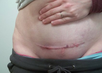 剖腹产后疤痕图片（1）
