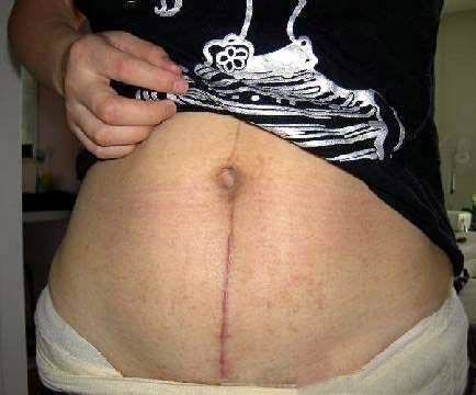 剖腹产后疤痕图片(2)