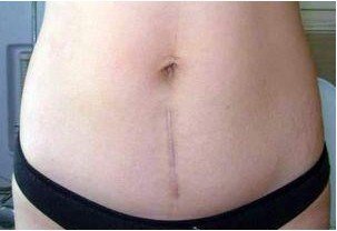 剖腹产后疤痕图片(3)
