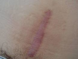 剖腹产后疤痕图片(4)